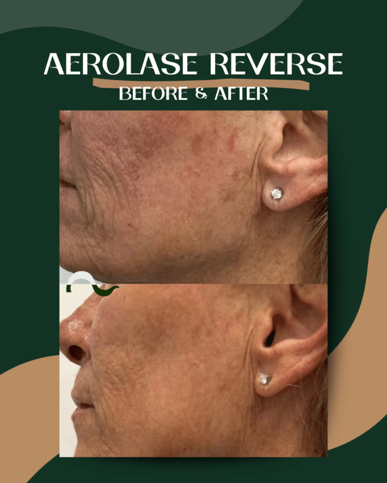 14AerolaseReverse