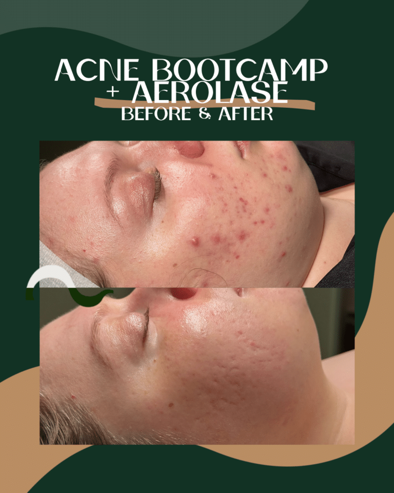 15AerolaseReverse+Acne