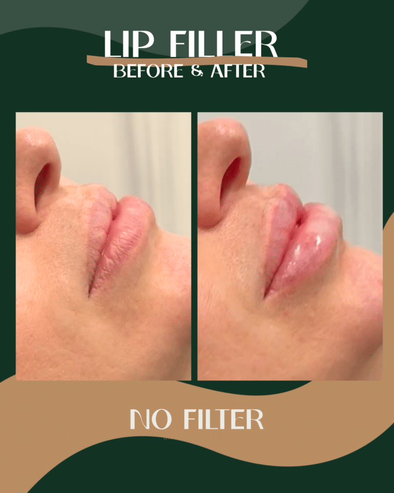 18DermalFiller