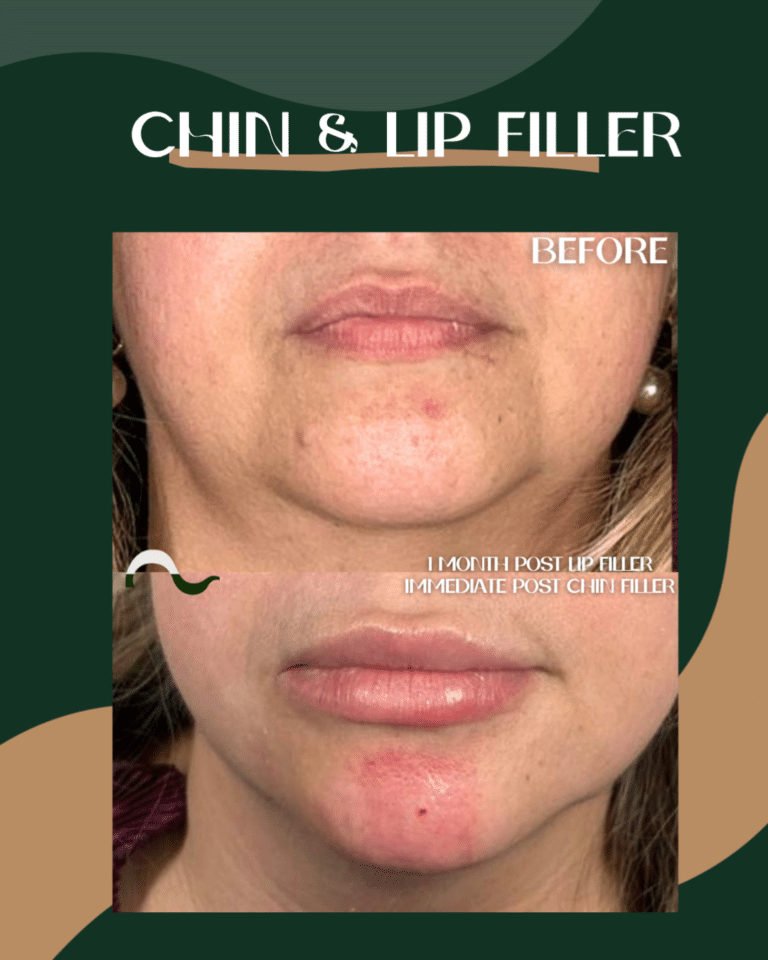 19DermalFiller