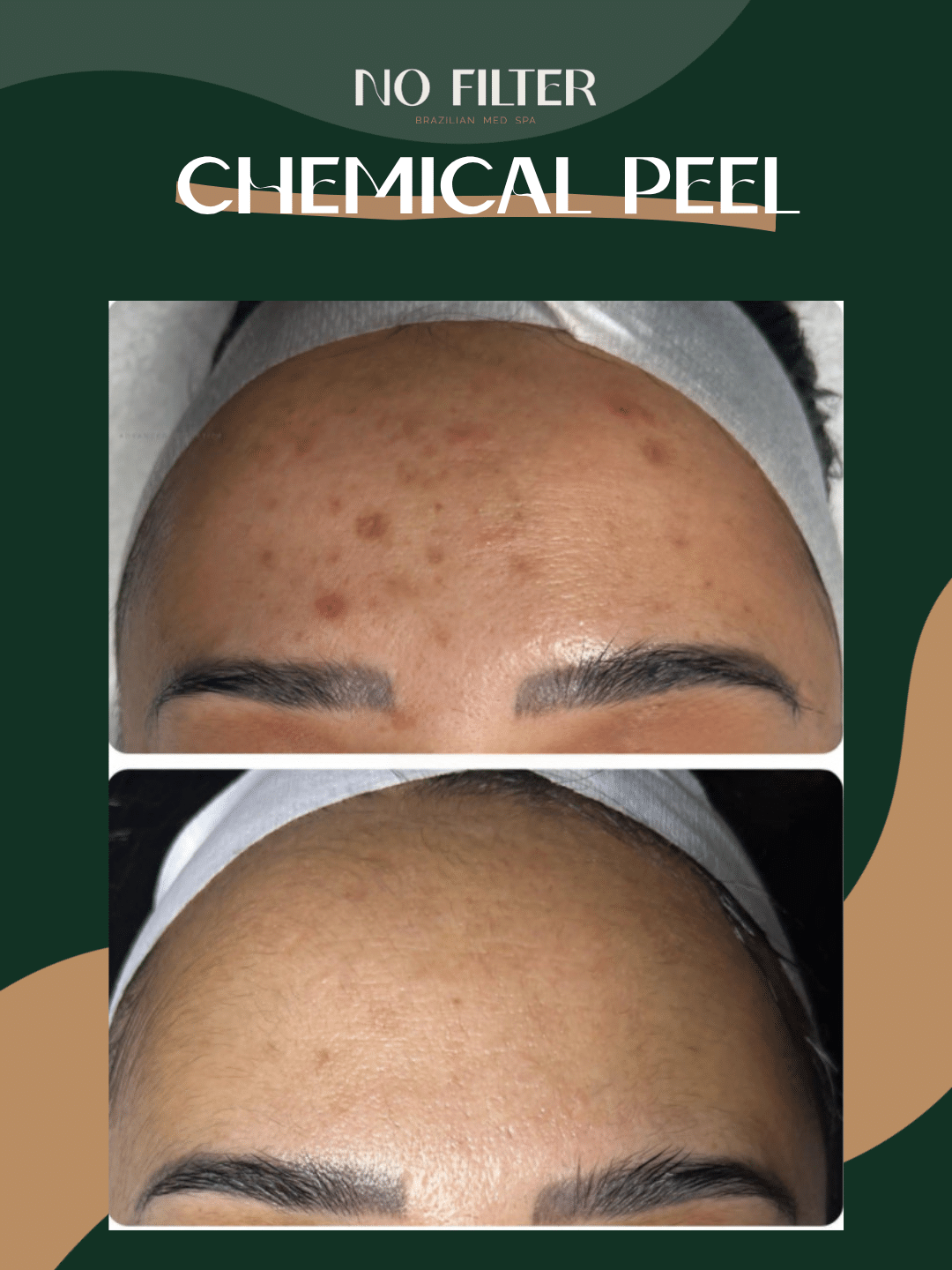 ChemicalPeel