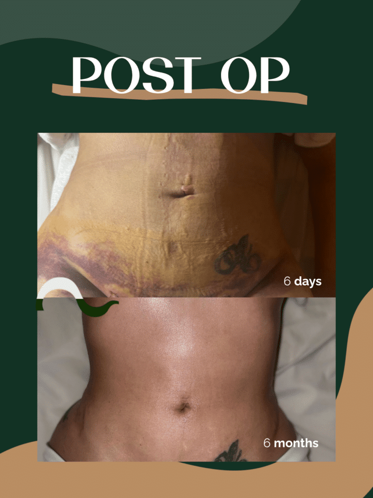 65-PostOP